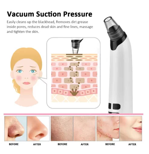 Face Vacuum Suction Blackhead Remover – Electric Pore Cleaner